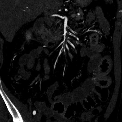 Case report: ultrasound assisted catheter directed thrombolysis of an embolic partial occlusion of the superior mesenteric artery